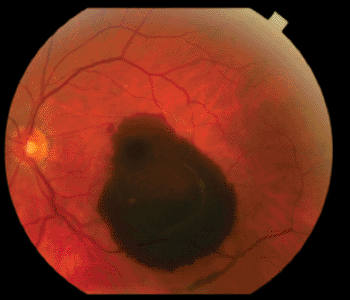 Imagen A: Una hemorragia sub-retiniana en un paciente con degeneración macular húmeda (Fotografía cortesía del Laboratorio Chavala, Universidad de Carolina del Norte).